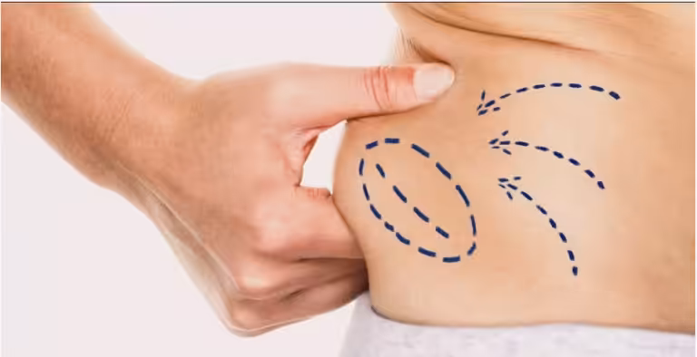 Liposuction in Dubai Trend Rise Shaping Modern Body Contouring